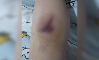 Укус собаки